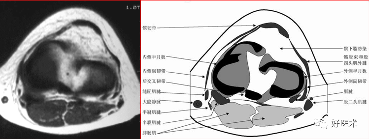 影像PPT - 半月板详细解剖及损伤的详细讲解-32 影像PPT - 半月板详细解剖及损伤的详细讲解-32