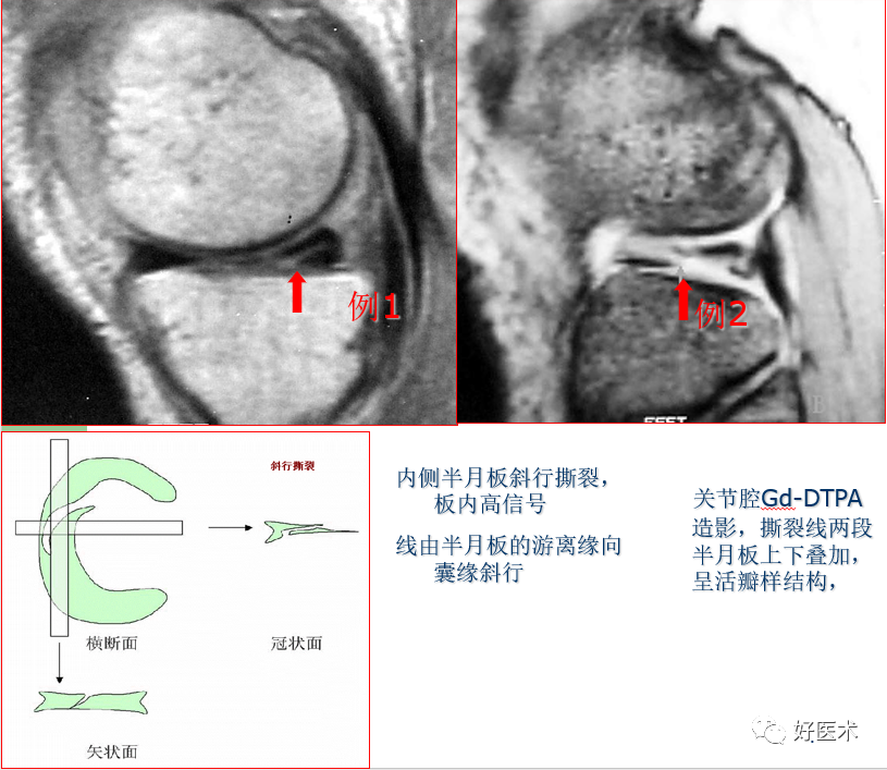 影像PPT - 半月板详细解剖及损伤的详细讲解-43 影像PPT - 半月板详细解剖及损伤的详细讲解-43