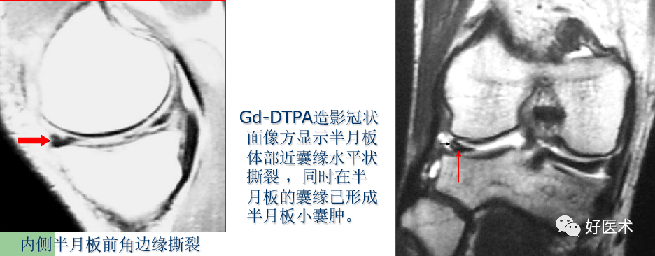 影像PPT - 半月板详细解剖及损伤的详细讲解-45 影像PPT - 半月板详细解剖及损伤的详细讲解-45