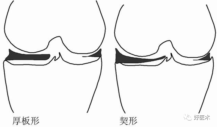 影像PPT - 半月板详细解剖及损伤的详细讲解-50 影像PPT - 半月板详细解剖及损伤的详细讲解-50