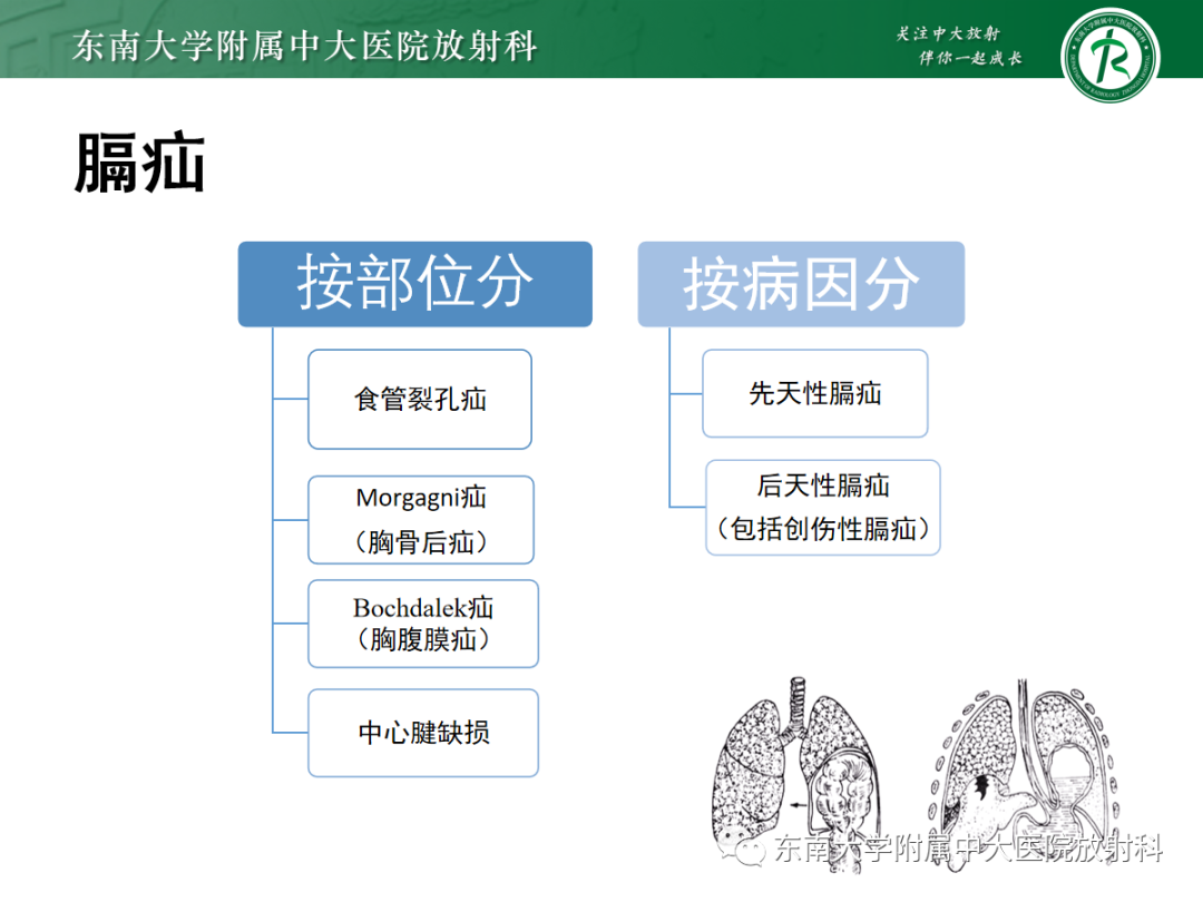 影像PPT - 【PPT】膈肌相关病变-9