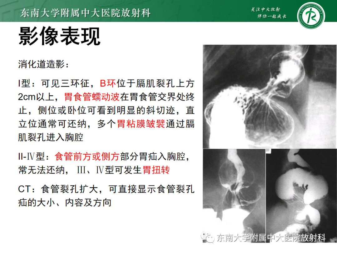 影像PPT - 【PPT】膈肌相关病变-13