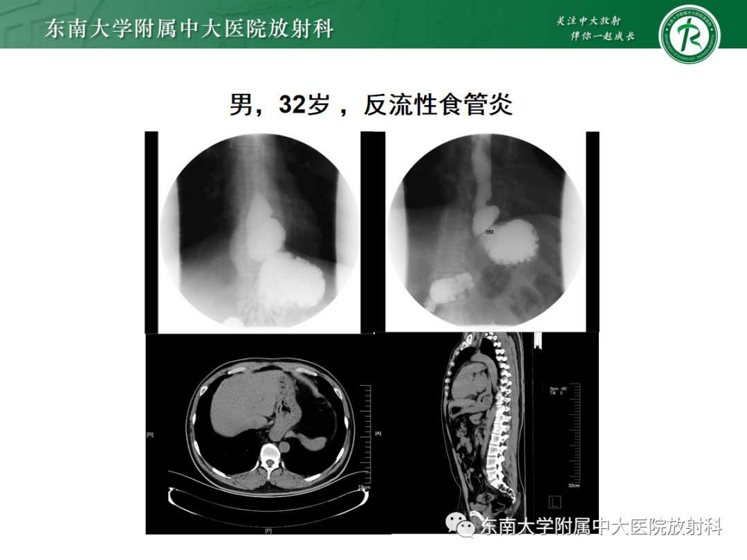 影像PPT - 【PPT】膈肌相关病变-14