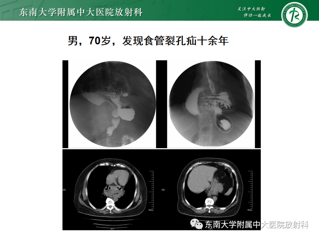 影像PPT - 【PPT】膈肌相关病变-15