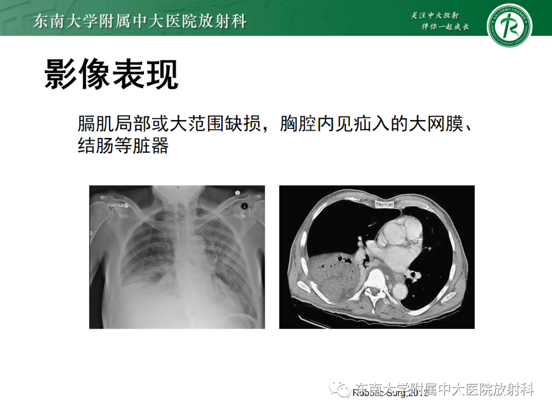 影像PPT - 【PPT】膈肌相关病变-18