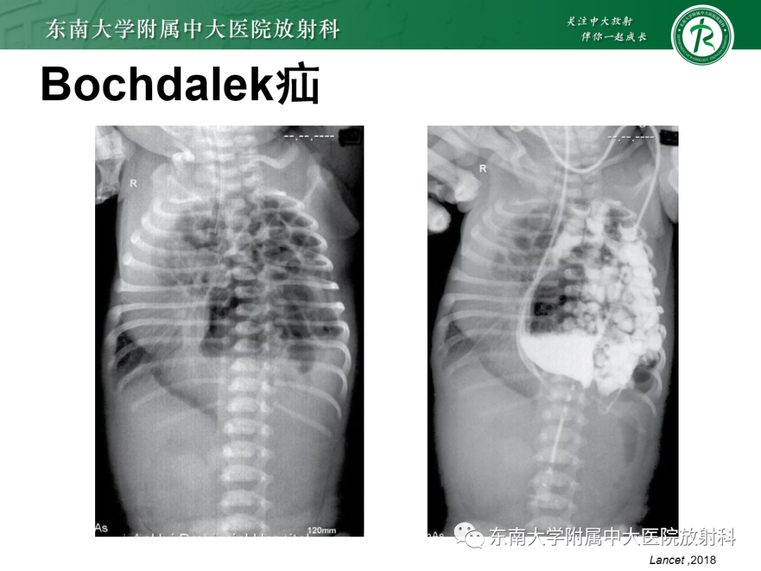 影像PPT - 【PPT】膈肌相关病变-19