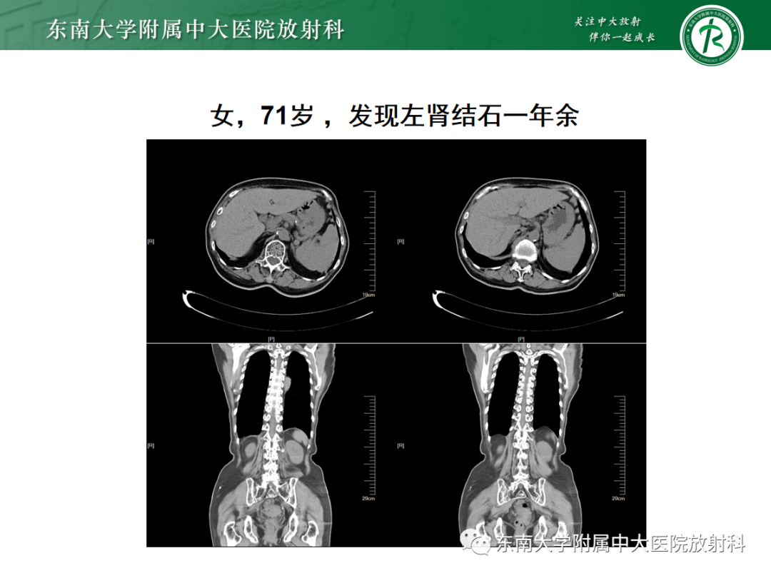 影像PPT - 【PPT】膈肌相关病变-20