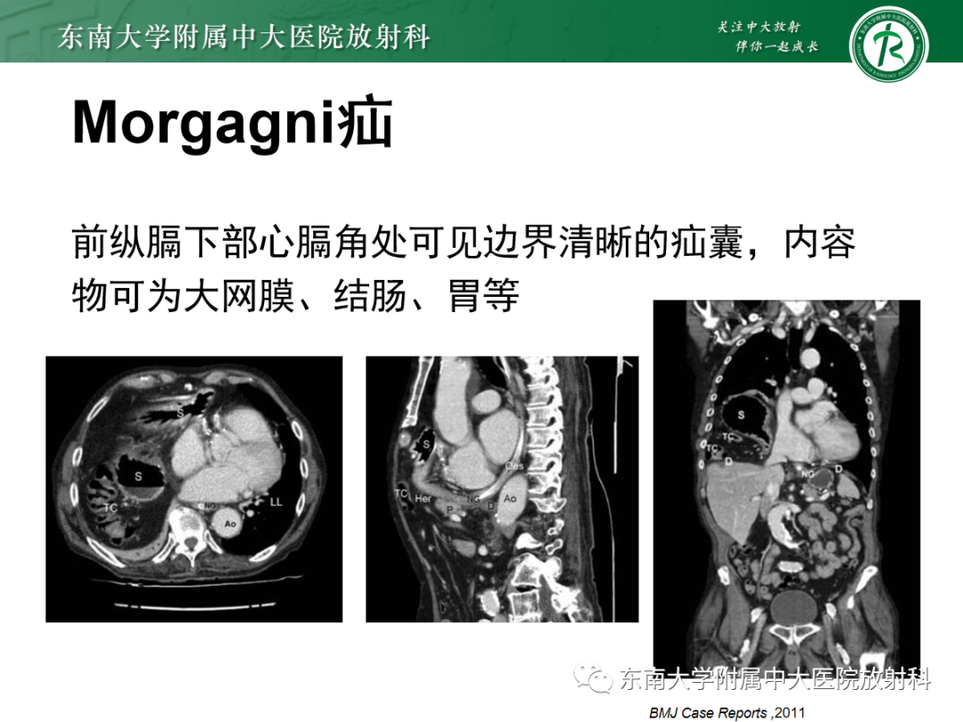 影像PPT - 【PPT】膈肌相关病变-22