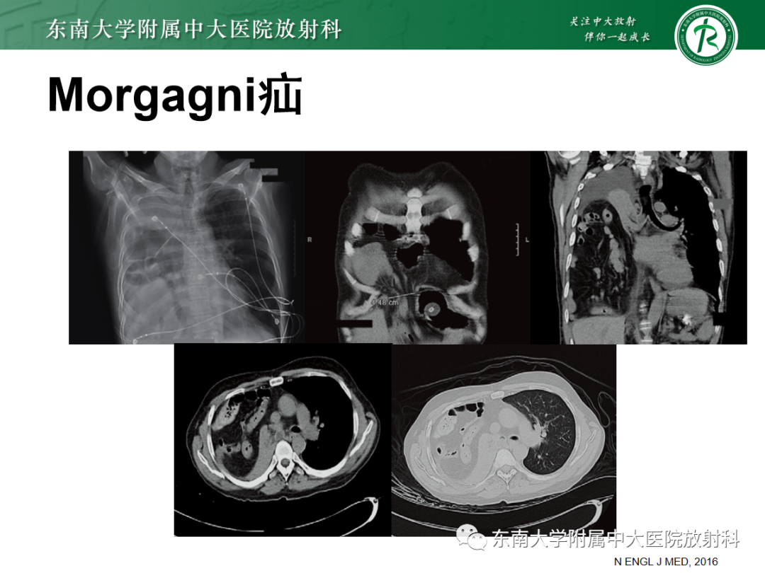 影像PPT - 【PPT】膈肌相关病变-23