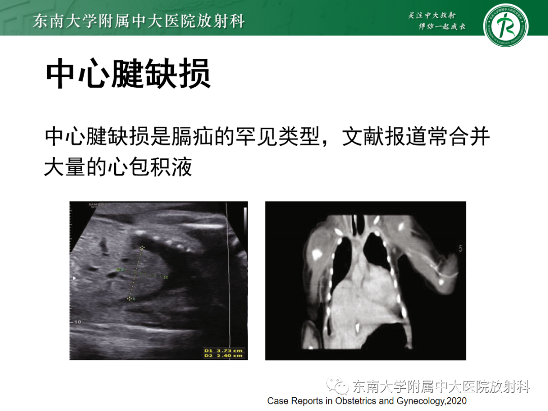 影像PPT - 【PPT】膈肌相关病变-25