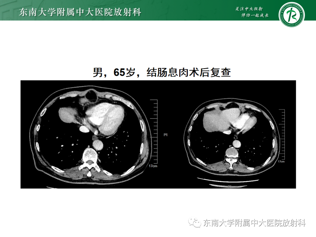 影像PPT - 【PPT】膈肌相关病变-24