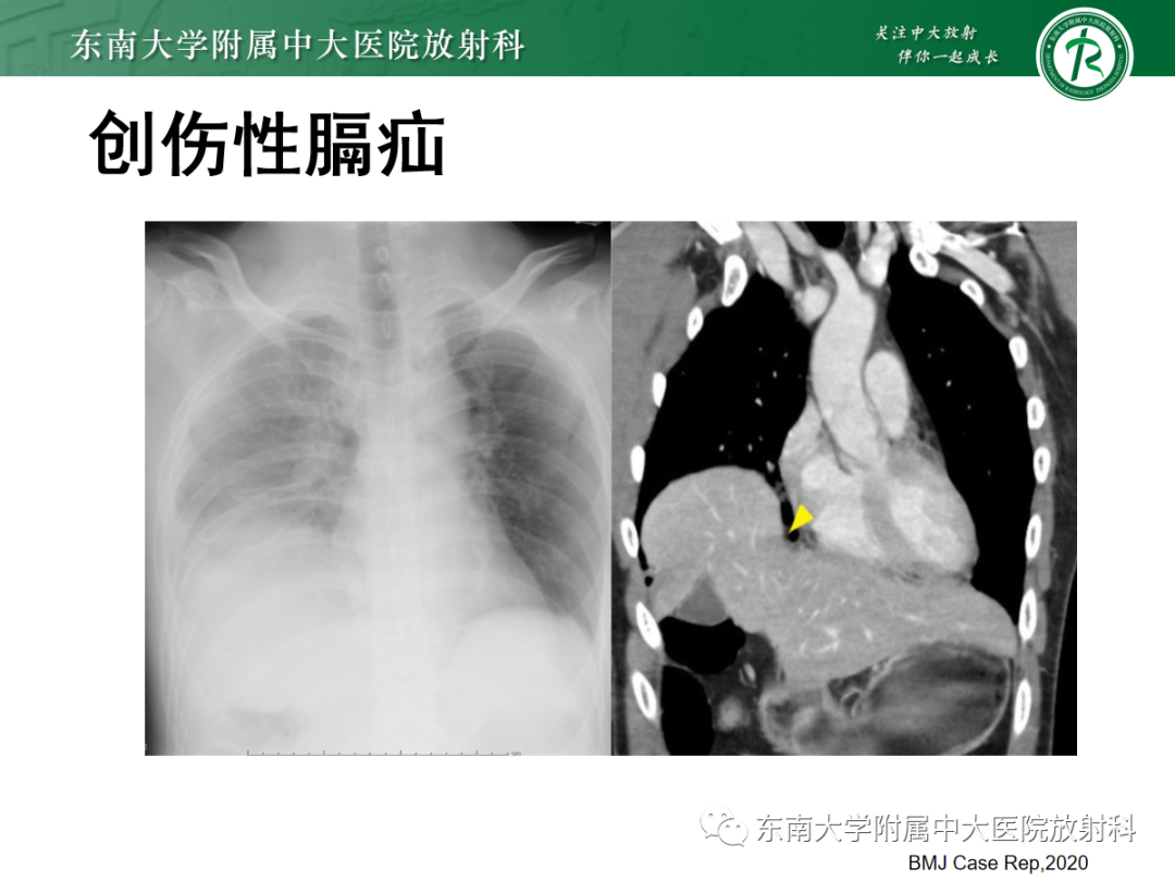 影像PPT - 【PPT】膈肌相关病变-30