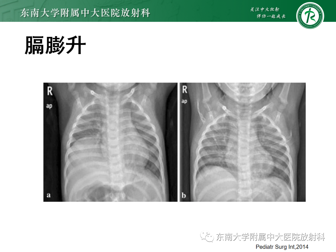影像PPT - 【PPT】膈肌相关病变-28