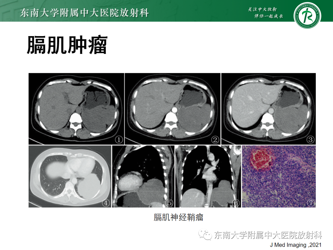 影像PPT - 【PPT】膈肌相关病变-33