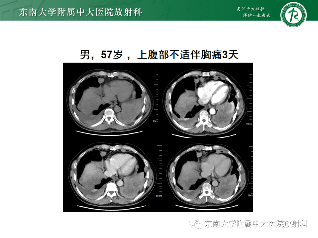 影像PPT - 【PPT】膈肌相关病变-34