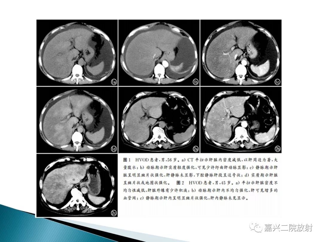影像PPT - 【PPT】肝小静脉闭塞症-12