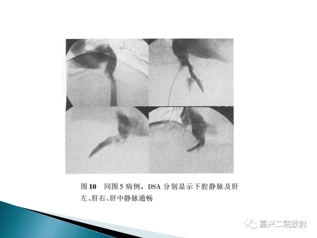 影像PPT - 【PPT】肝小静脉闭塞症-16