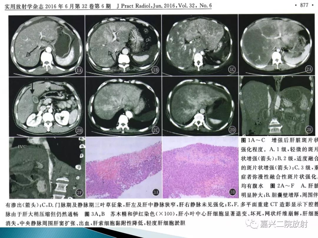 影像PPT - 【PPT】肝小静脉闭塞症-14
