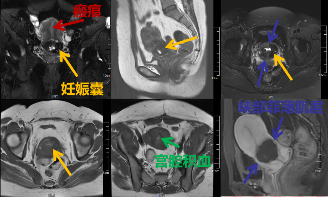 影像PPT - 磁共振如何诊断、评价瘢痕妊娠,看看这些典型病例-3 影像PPT - 磁共振如何诊断、评价瘢痕妊娠,看看这些典型病例-3