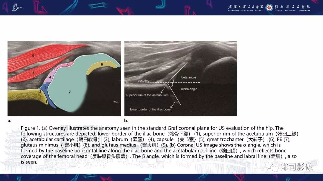 影像PPT - 【PPT】儿童、青少年髋部和下肢异常影像学诊断-7