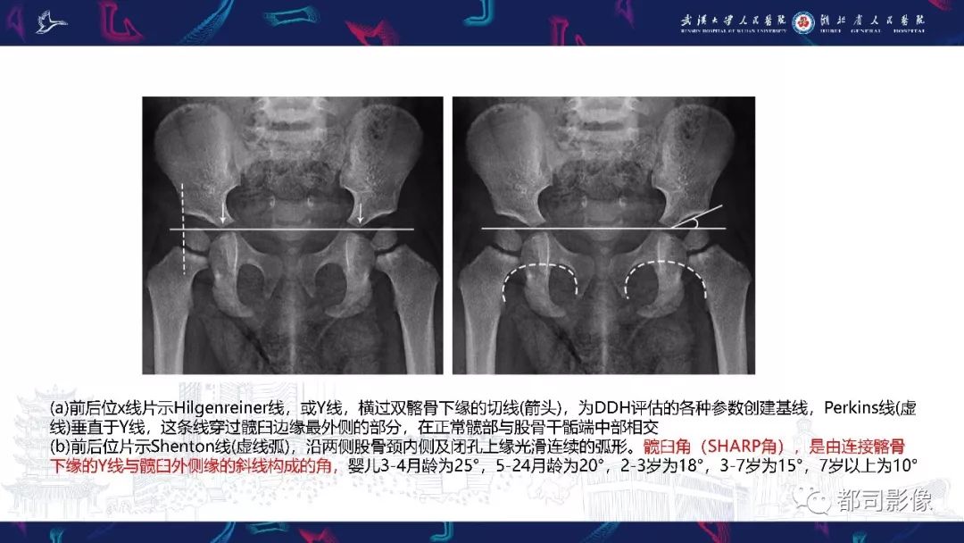 影像PPT - 【PPT】儿童、青少年髋部和下肢异常影像学诊断-11