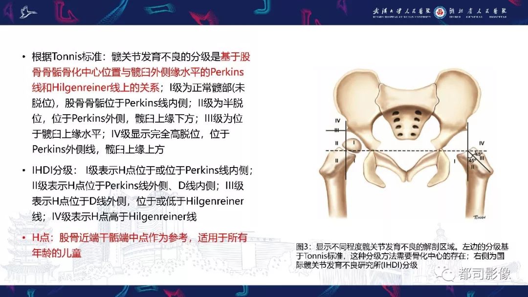 影像PPT - 【PPT】儿童、青少年髋部和下肢异常影像学诊断-12