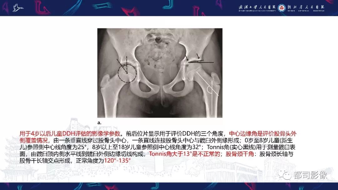 影像PPT - 【PPT】儿童、青少年髋部和下肢异常影像学诊断-13