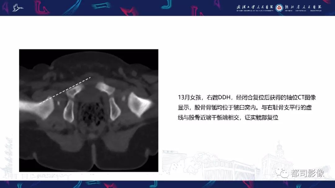 影像PPT - 【PPT】儿童、青少年髋部和下肢异常影像学诊断-15