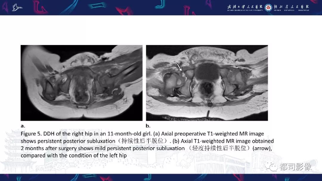 影像PPT - 【PPT】儿童、青少年髋部和下肢异常影像学诊断-16