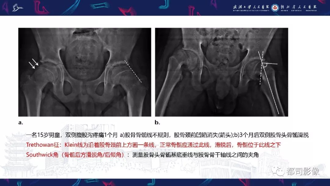 影像PPT - 【PPT】儿童、青少年髋部和下肢异常影像学诊断-19