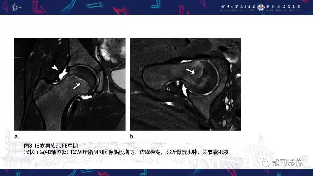 影像PPT - 【PPT】儿童、青少年髋部和下肢异常影像学诊断-21