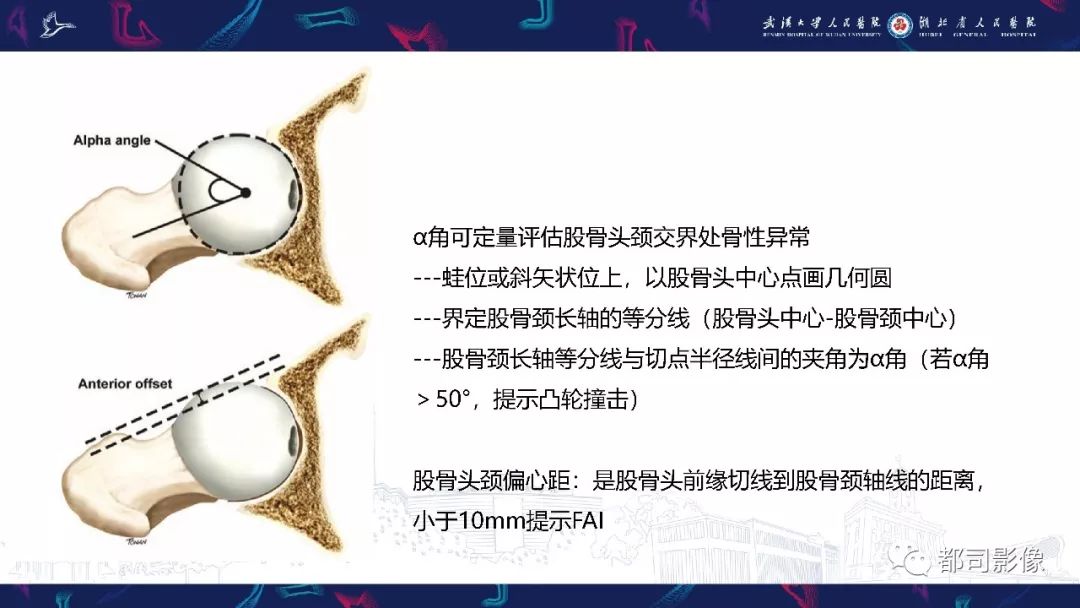 影像PPT - 【PPT】儿童、青少年髋部和下肢异常影像学诊断-28
