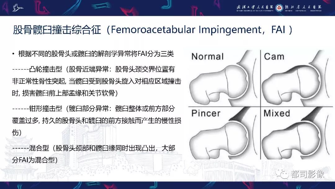 影像PPT - 【PPT】儿童、青少年髋部和下肢异常影像学诊断-25