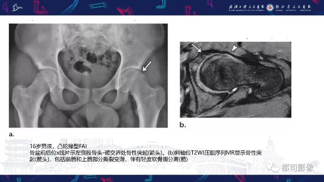影像PPT - 【PPT】儿童、青少年髋部和下肢异常影像学诊断-29