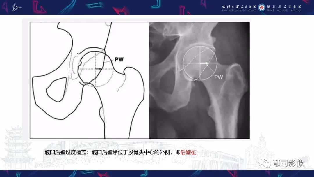 影像PPT - 【PPT】儿童、青少年髋部和下肢异常影像学诊断-34