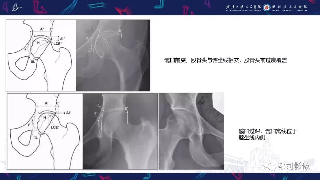 影像PPT - 【PPT】儿童、青少年髋部和下肢异常影像学诊断-35