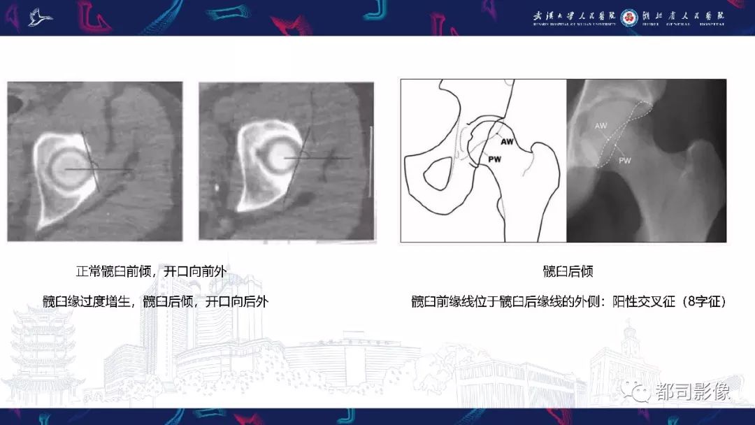 影像PPT - 【PPT】儿童、青少年髋部和下肢异常影像学诊断-32