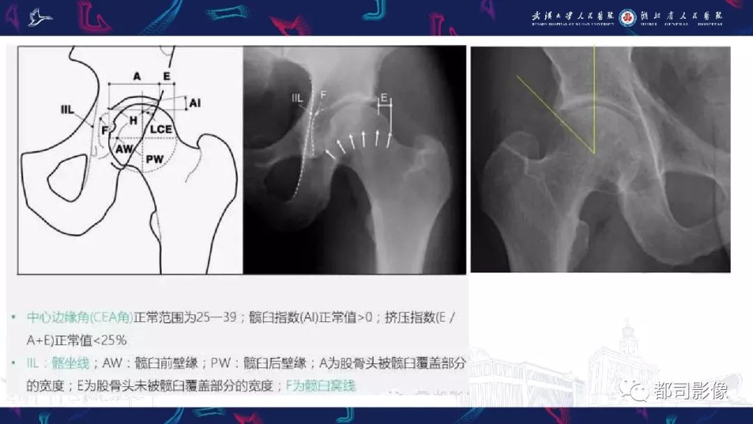 影像PPT - 【PPT】儿童、青少年髋部和下肢异常影像学诊断-31