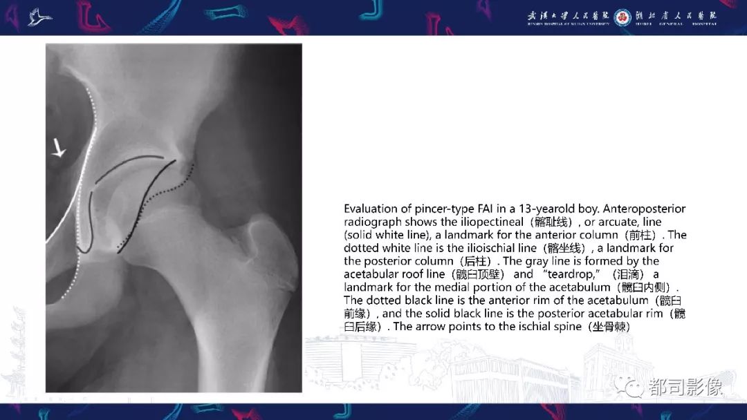 影像PPT - 【PPT】儿童、青少年髋部和下肢异常影像学诊断-33