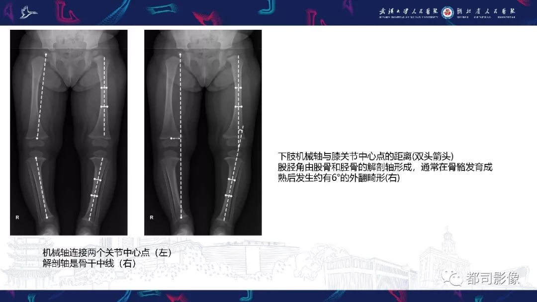 影像PPT - 【PPT】儿童、青少年髋部和下肢异常影像学诊断-38