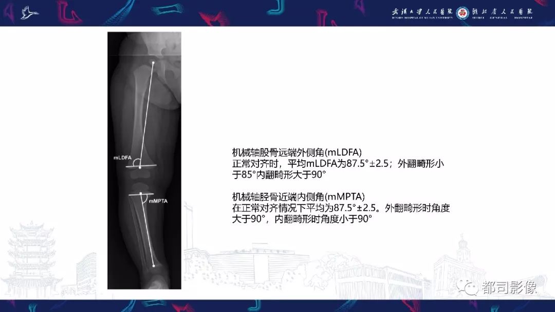 影像PPT - 【PPT】儿童、青少年髋部和下肢异常影像学诊断-40