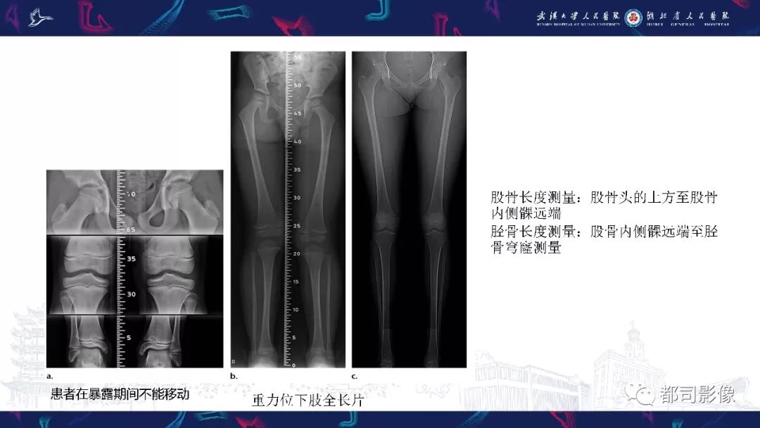 影像PPT - 【PPT】儿童、青少年髋部和下肢异常影像学诊断-42