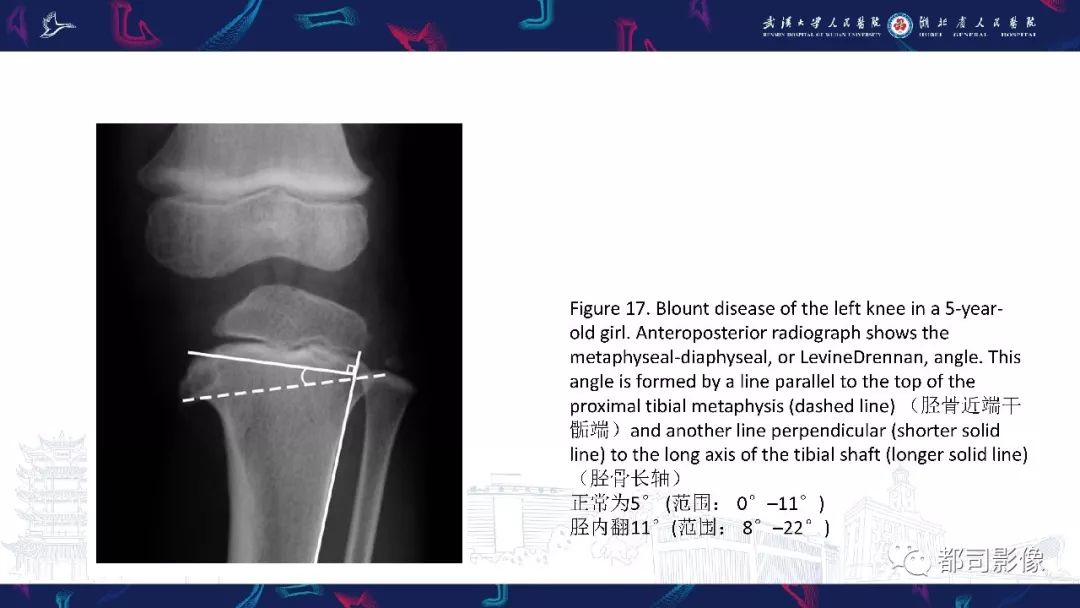 影像PPT - 【PPT】儿童、青少年髋部和下肢异常影像学诊断-45