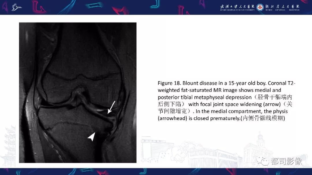 影像PPT - 【PPT】儿童、青少年髋部和下肢异常影像学诊断-46