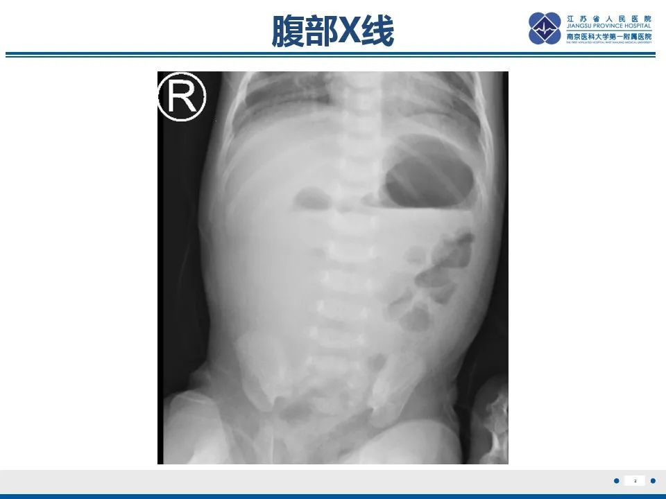 影像PPT - 【PPT】先天性肠旋转不良伴中肠扭转-3