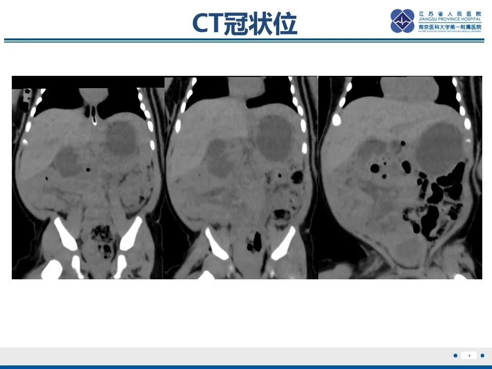 影像PPT - 【PPT】先天性肠旋转不良伴中肠扭转-5