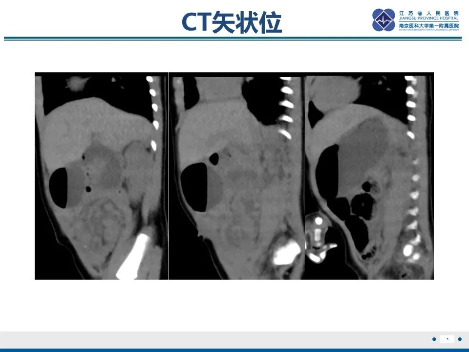 影像PPT - 【PPT】先天性肠旋转不良伴中肠扭转-6