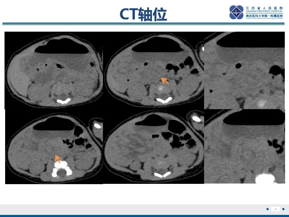 影像PPT - 【PPT】先天性肠旋转不良伴中肠扭转-4
