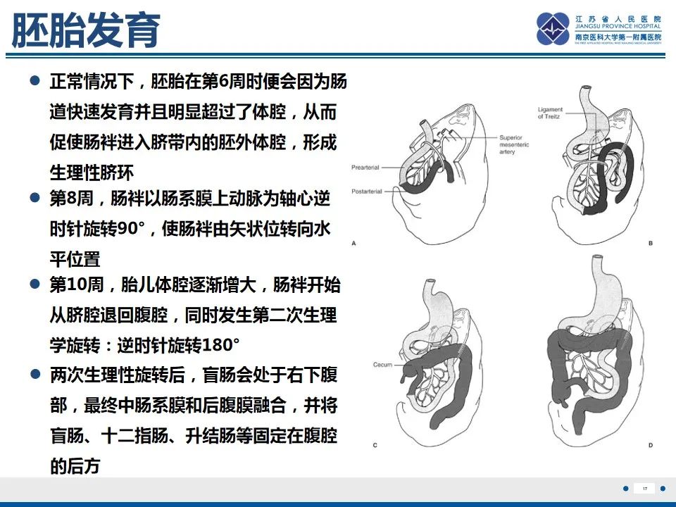 影像PPT - 【PPT】先天性肠旋转不良伴中肠扭转-18