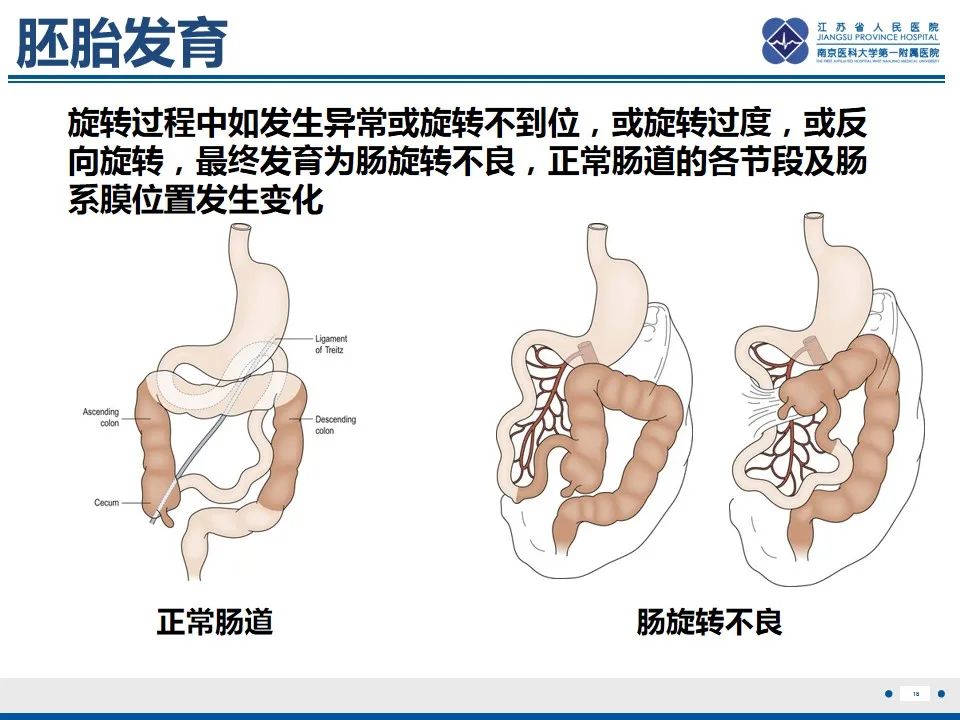 影像PPT - 【PPT】先天性肠旋转不良伴中肠扭转-19